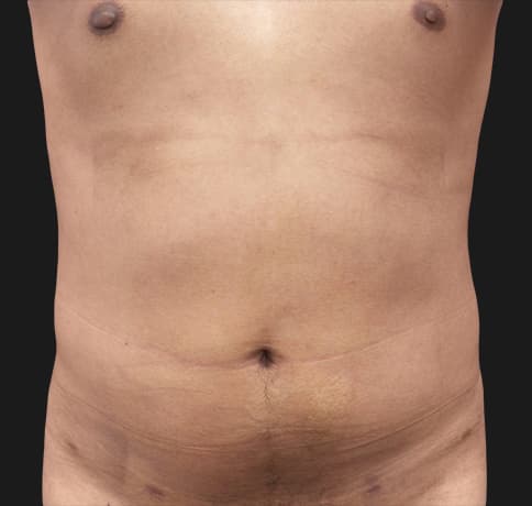 Case 41765, Performed By Dr. Tehrani – After