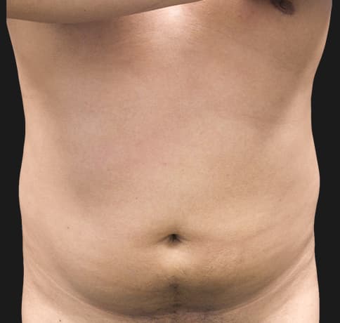 Case 41765, Performed By Dr. Tehrani – Before