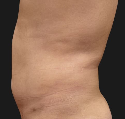 Case 41765, Performed By Dr. Tehrani – After