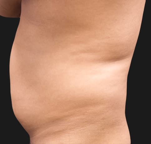 Case 41765, Performed By Dr. Tehrani – Before