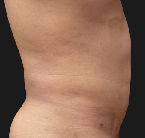Case 41765, Performed By Dr. Tehrani – angle 3 After