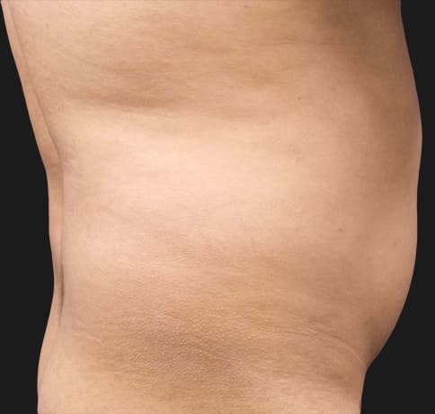 Case 41765, Performed By Dr. Tehrani – angle 3 Before