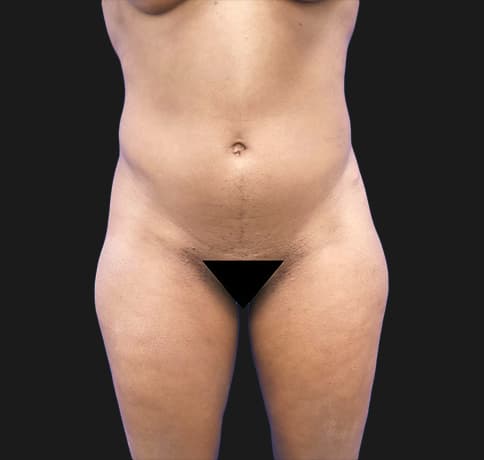 Case 40506, Performed By Dr. Tehrani – Before