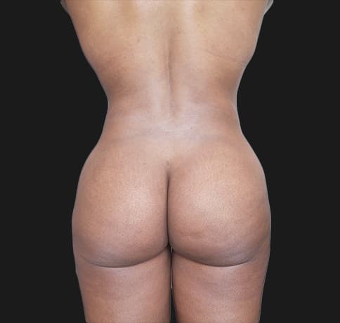 Case 40506, Performed By Dr. Tehrani – angle 4 After