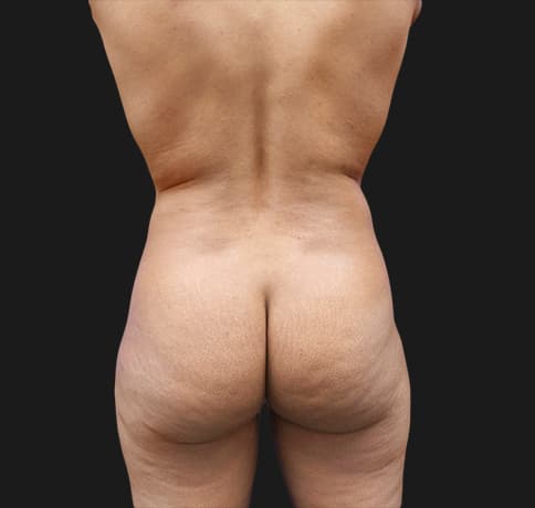 Case 40506, Performed By Dr. Tehrani – angle 4 Before