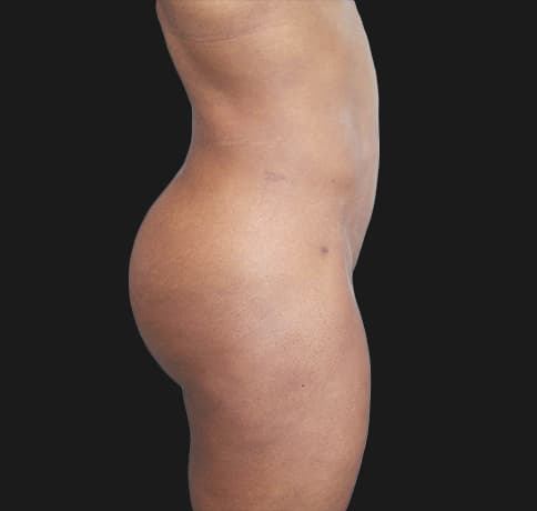 Case 40506, Performed By Dr. Tehrani – angle 2 After