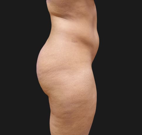 Case 40506, Performed By Dr. Tehrani – angle 2 Before