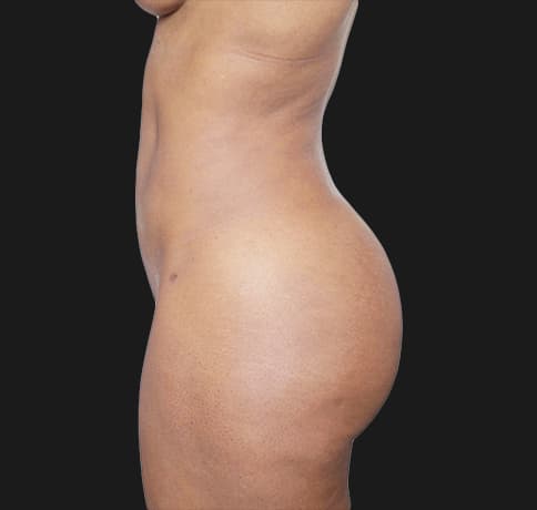 Case 40506, Performed By Dr. Tehrani – angle 3 After