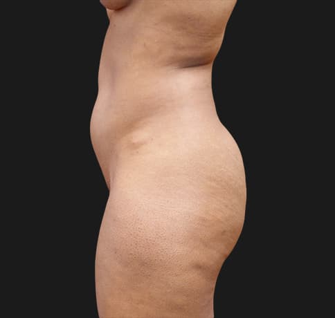 Case 40506, Performed By Dr. Tehrani – angle 3 Before