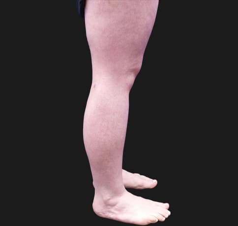 Case 42619, Performed By Dr. Tehrani – angle 3 After