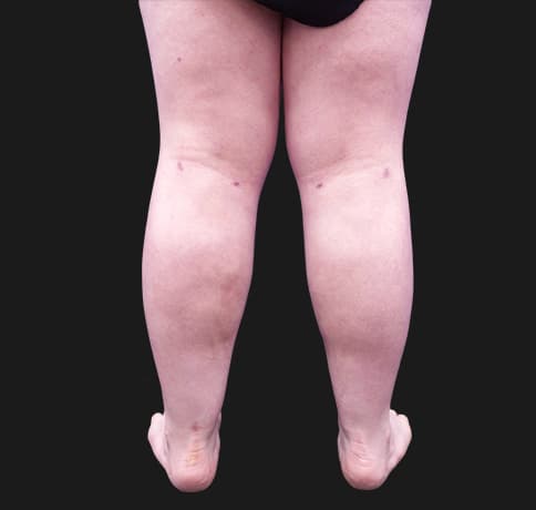Case 42619, Performed By Dr. Tehrani – angle 5 After