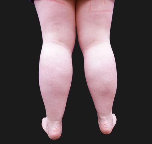 Case 42619, Performed By Dr. Tehrani – angle 5 Before