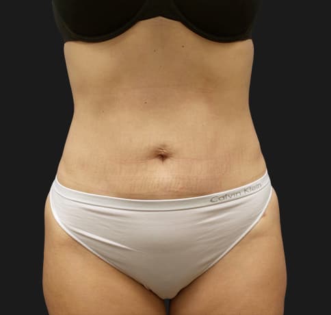 Case 41767, Performed By Dr. Tehrani – After