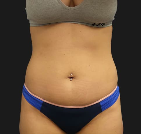 Case 41767, Performed By Dr. Tehrani – Before