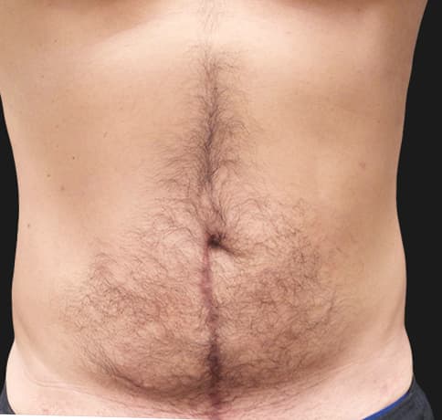 Case 42596, Performed By Dr. Tehrani – After