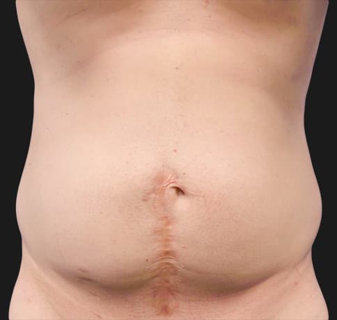Case 42596, Performed By Dr. Tehrani – Before