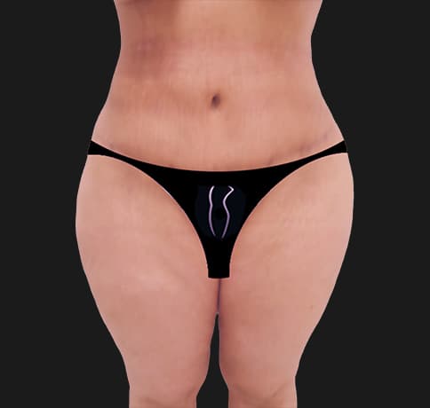 Case 44594, Performed By Dr. Tehrani – After