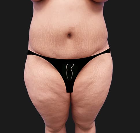 Case 44594, Performed By Dr. Tehrani – Before