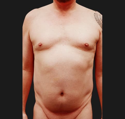 Case 57970, Performed By Dr. Tehrani – Before