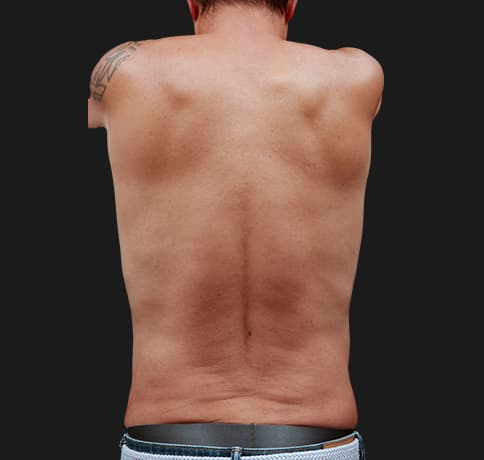 Case 57970, Performed By Dr. Tehrani – angle 3 After