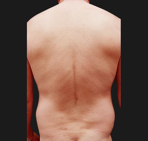 Case 57970, Performed By Dr. Tehrani – angle 3 Before