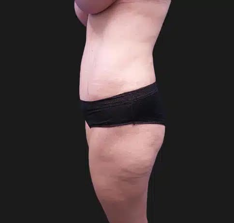 Case 39896, Performed By Dr. Tehrani – angle 3 After