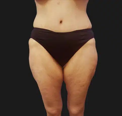 Case 15980, Performed By Dr. Tehrani – After