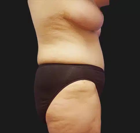 Case 15980, Performed By Dr. Tehrani – After