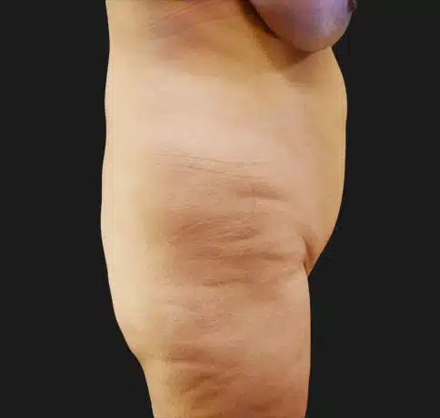 Case 15980, Performed By Dr. Tehrani – Before