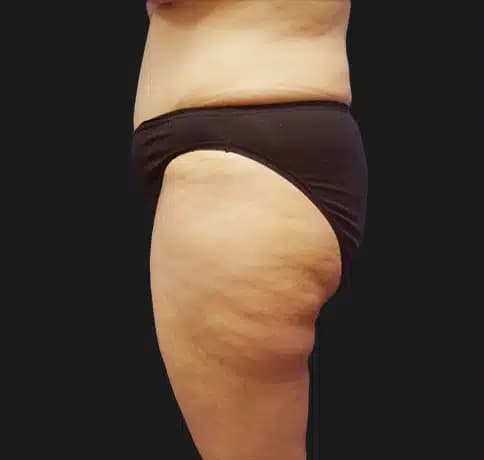 Case 15980, Performed By Dr. Tehrani – angle 3 After