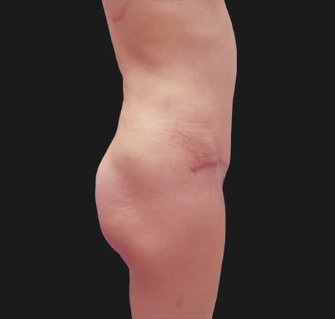 Case 44340, Performed By Dr. Tehrani – angle 2 After