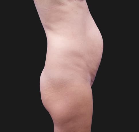 Case 44340, Performed By Dr. Tehrani – angle 2 Before