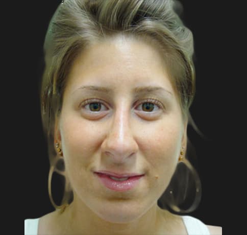 Case 5780 , Performed By Dr. Tehrani – angle 3 After