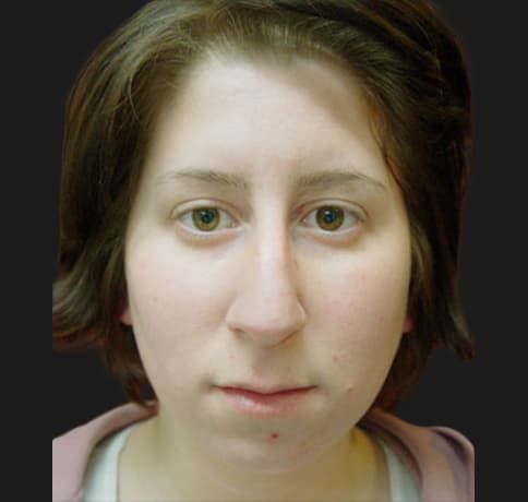 Case 5780 , Performed By Dr. Tehrani – angle 3 Before