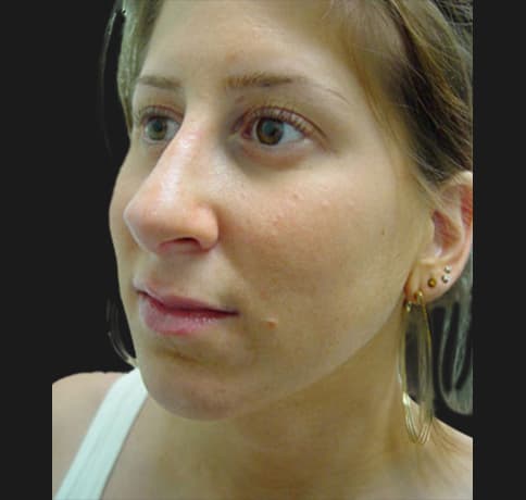 Case 5780 , Performed By Dr. Tehrani – angle 4 After