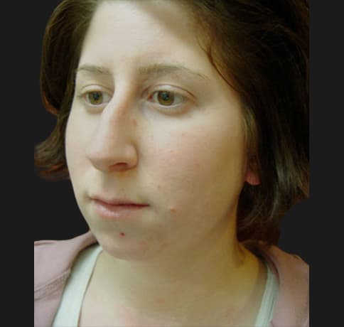 Case 5780 , Performed By Dr. Tehrani – angle 4 Before