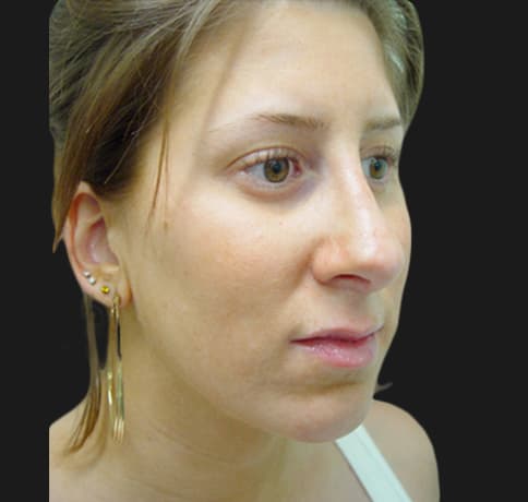 Case 5780 , Performed By Dr. Tehrani – angle 5 After