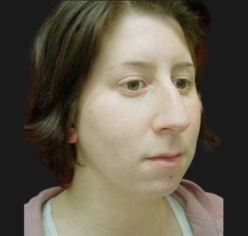 Case 5780 , Performed By Dr. Tehrani – angle 5 Before