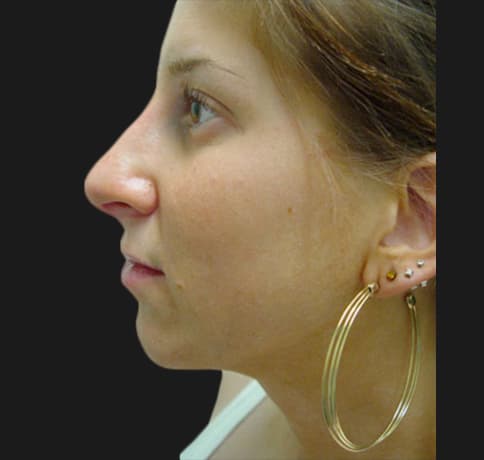 Case 5780 , Performed By Dr. Tehrani – After