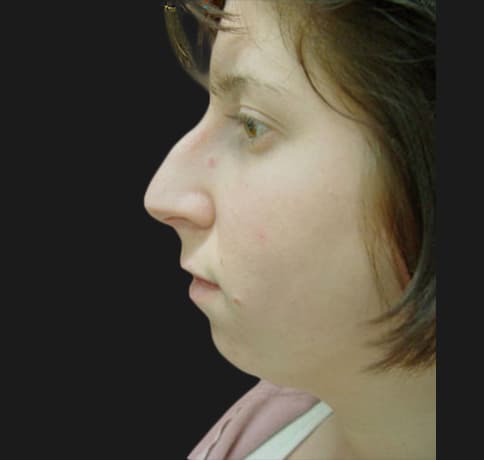 Case 5780 , Performed By Dr. Tehrani – Before