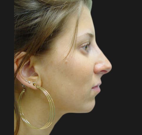 Case 5780 , Performed By Dr. Tehrani – After