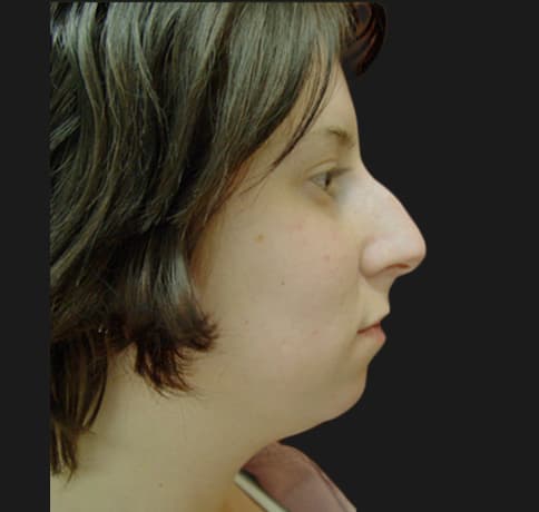 Case 5780 , Performed By Dr. Tehrani – Before