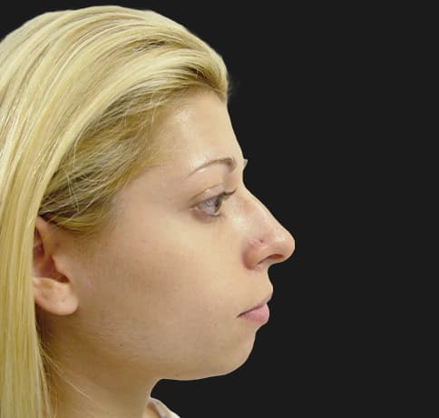 Case 7119 , Performed By Dr. Tehrani – Before