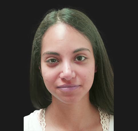 Case 34106 , Performed By Dr. Tehrani – angle 3 After