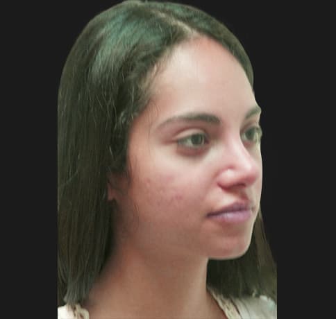 Case 34106 , Performed By Dr. Tehrani – angle 5 After
