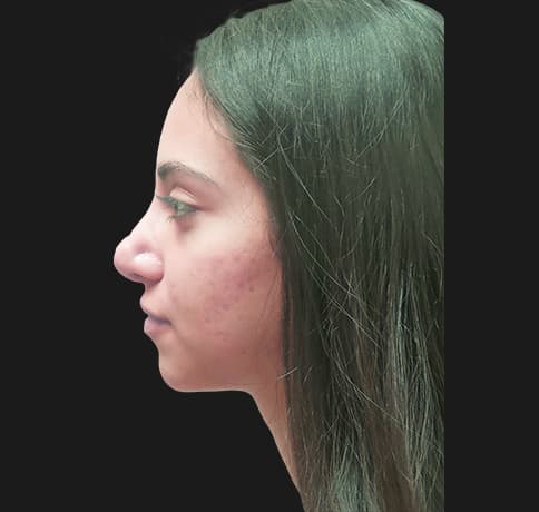 Case 34106 , Performed By Dr. Tehrani – angle 2 After