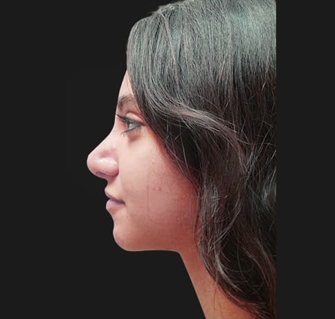 Case 34106 , Performed By Dr. Tehrani – angle 2 Before