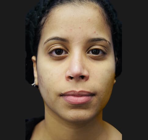 Case 21237 , Performed By Dr. Tehrani – angle 2 After