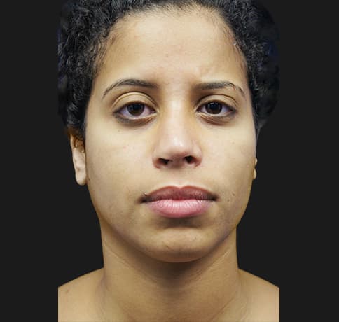Case 21237 , Performed By Dr. Tehrani – angle 2 Before
