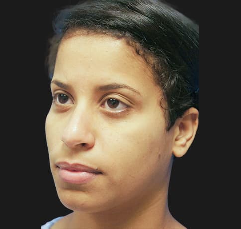 Case 21237 , Performed By Dr. Tehrani – angle 3 Before